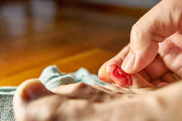 A bloody, bursting callus on the little toe.