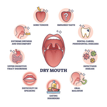 Dry mouth or xerostomia as salivary glands saliva problem outline diagram. Labeled educational scheme with medical mouth condition, symptoms and causes vector illustration. Dental health disease.