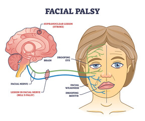 Facial palsy and muscles weakness because of nerve damage outline diagram. Labeled educational scheme with anatomical brain supranuclear stroke caused dropping mouth and eye vector illustration.