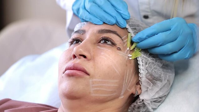 Thread lifting is a cosmetological procedure for face rejuvenation. The beautician implants cosmetic threads under the skin to relieve facial ptosis.