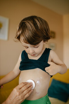 Boy with varichella 