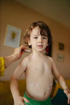 Boy with varichella 