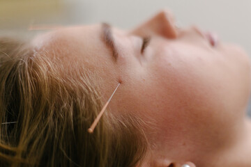 Acupuncture
