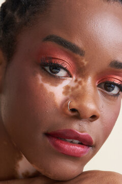 Close Up Image of Young Black Woman with Vitiligo Featuring Skin
