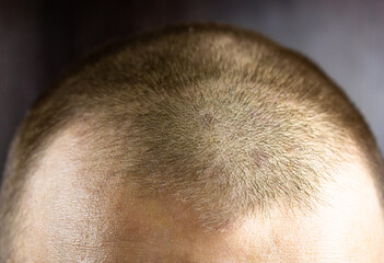 Short men's haircut close-up. Short hair on the head.