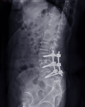 X-ray image of Lumbar spine with pedicle screw fixation.
