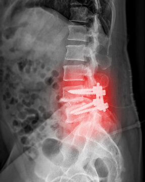 X-ray image of Lumbar spine with pedicle screw fixation.