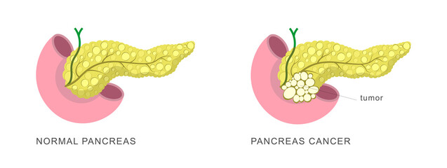 Pancreatic cancer concept. Tumor demonstrated on pancreas compared to healthy one. Disease diagnostic illustration for education material, brochure, website, medical portal, atlas, textbook