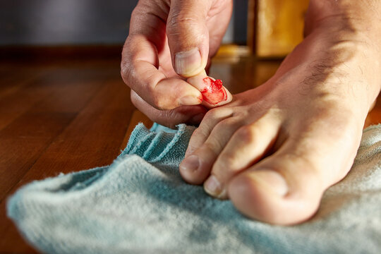 A bloody, bursting callus on the little toe.