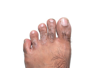 Image of a man's feet on a white background with fungal dermatitis on the toes causing peeling,...