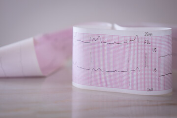 Tracing of an electrocardiogram with cardiac arrhythmia.