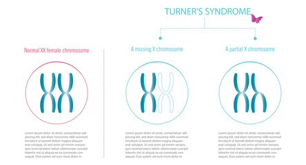 Turner syndrome, representation of XX chromosomes with total or partial lack of X. - obrazy, fototapety, plakaty
