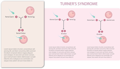 Infographic of sperm and egg with and without Turner's syndrome.. - obrazy, fototapety, plakaty