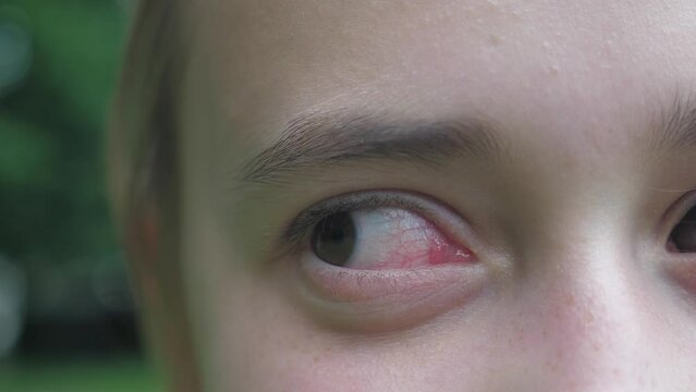 A teenage girl with a red eye from inflammation. The girl looks around. Red eye from allergies.