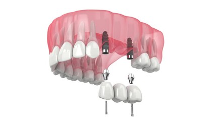 Upper jaw with dental bridge supported by implants 