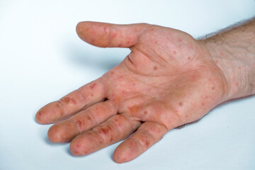 Male hands with Monkeypox rash. Patient with MonkeyPox viral disease. Close Up of Painful rash, red spots blisters on the skin. Human palm with Health problem. Banner, copy space. Allergy, dermatitis