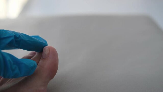 A close-up of a foot with a fungus on the nails is examined by a doctor in gloves. Onycholysis: detachment of the nail from the nail bed.