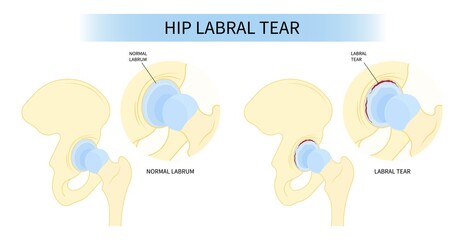 Labral cartilage of hip bone Pain and range of motion groin head tear Treat joint thigh femur injury spurs socket lesion - obrazy, fototapety, plakaty