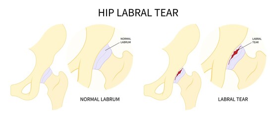 Trauma injury of hip bone Pain and range of motion groin head tear Treat joint thigh femur injury spurs socket lesion