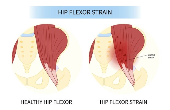 Hip Flexor Stretch Pain Of Coxa Saltans Rectus Bursae Intra Groin Broken Strain Iliacus Psoas Torn Major Band Joint Tear Thigh Tract Labral Tensor Femur Tendon Injury Muscle Greater Trauma Labrum