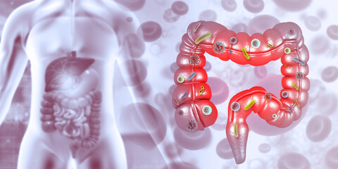 Human digestive system infected by virus or bacteria. 3d illustration