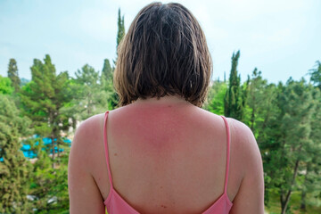 Dangerous sunburn. Woman skin on back after sunbathing on beach. Concept of using  Sunscreen or UV...
