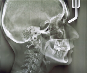 X-ray of the head, jaws. Stages of installing braces. Visiting an orthodontist