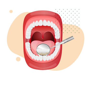 Tender Gums with Plaque - stock illustration