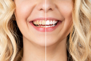 Smiling woman before and after the teeth whitening procedure, close-up image.