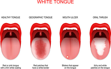 Sore or white tongue - obrazy, fototapety, plakaty