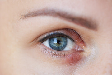 Fototapeta na wymiar Peeling and swelling on the eyelid of the human eye