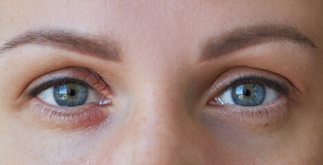 Peeling and swelling on the eyelid of the human eye