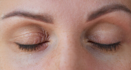 Peeling and swelling on the eyelid of the human eye from conjunctivitis