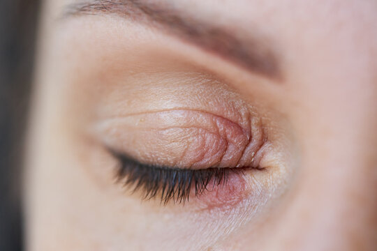 Peeling and swelling on the eyelid of the human eye