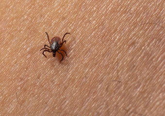 Infected female deer tick on hairy human skin. Ixodes ricinus. Parasitic mite. Acarus. Dangerous biting insect on background of epidermis detail. Disgusting carrier of infections. Tick-borne diseases