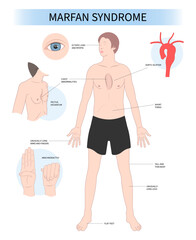 Marfan’s syndrome genetic condition disease Enlarged Heart syndrome malformation Gene Mutation