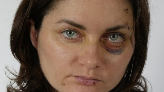 Large real bruise hematoma under the eye of a young woman, purple bruise. Broken lip and forehead wound. terrified face of domestic violence victim close-up white background.
