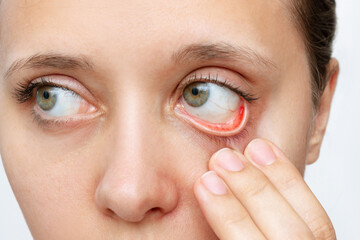 Cropped shot of a young caucasian woman showing off her red inflamed conjunctiva and dilated...