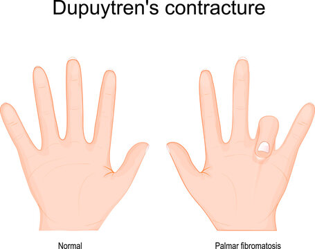 Dupuytren's contracture. Comparison and difference of a healthy hand and Dupuytren's disease in left hand.