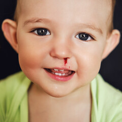 Happy toddler baby boy with a bloody nose. Bleeding from the nose of a smiling child. Kid at the age of one year