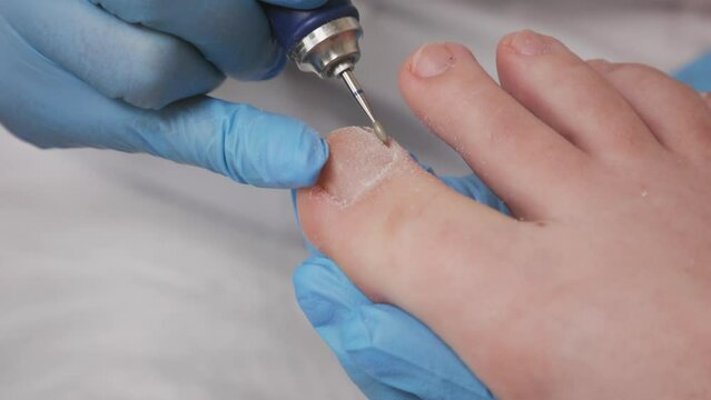Podiatrist polishes the toe cuticle toe fingers with a mechanical device with a abrasive nozzle. Close-up, top view. The concept of a podology and chiropody.