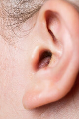 Fototapeta premium Close up of abscess Inflammation on the ear, area of suppuration. Ear furuncle. Purulent carbuncle. Treatment of abscess