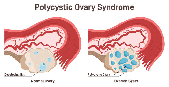 Polycystic ovary syndrome. PCOS hormonal disease. Female reproductive