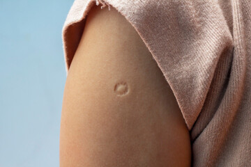 Bacillus Calmette-Guern Vaccine,  BCG or TB vaccine scar mark at the arm of Southeast Asian women.
