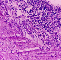 Microscopic image of neck mass cancer, Metastatic adenocarcinoma, show skin, fatty tissue,...