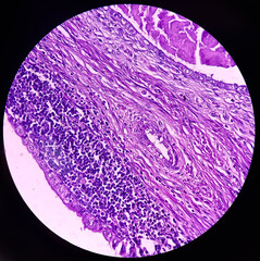 Microscopic image of neck mass cancer, Metastatic adenocarcinoma, show skin, fatty tissue, grandular component of cystic teratoma of testis.