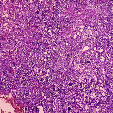 Tumor From Dorsal Spine (biopsy): Psammomatous Meningioma. Heavily Calcified Intracranial Or Spinal Mass Lesion, Show Soft Tissue Of Spine.