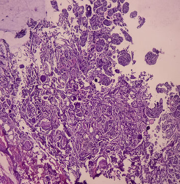 Tumor From Dorsal Spine (biopsy): Psammomatous Meningioma. Heavily Calcified Intracranial Or Spinal Mass Lesion, Show Soft Tissue Of Spine.