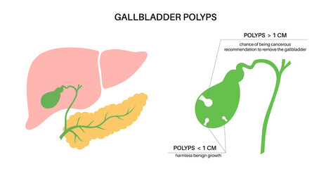 Gallbladder polyp anatomy - obrazy, fototapety, plakaty