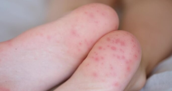 Red spots of rash on feet of child from enterovirus infection closeup 4k movie